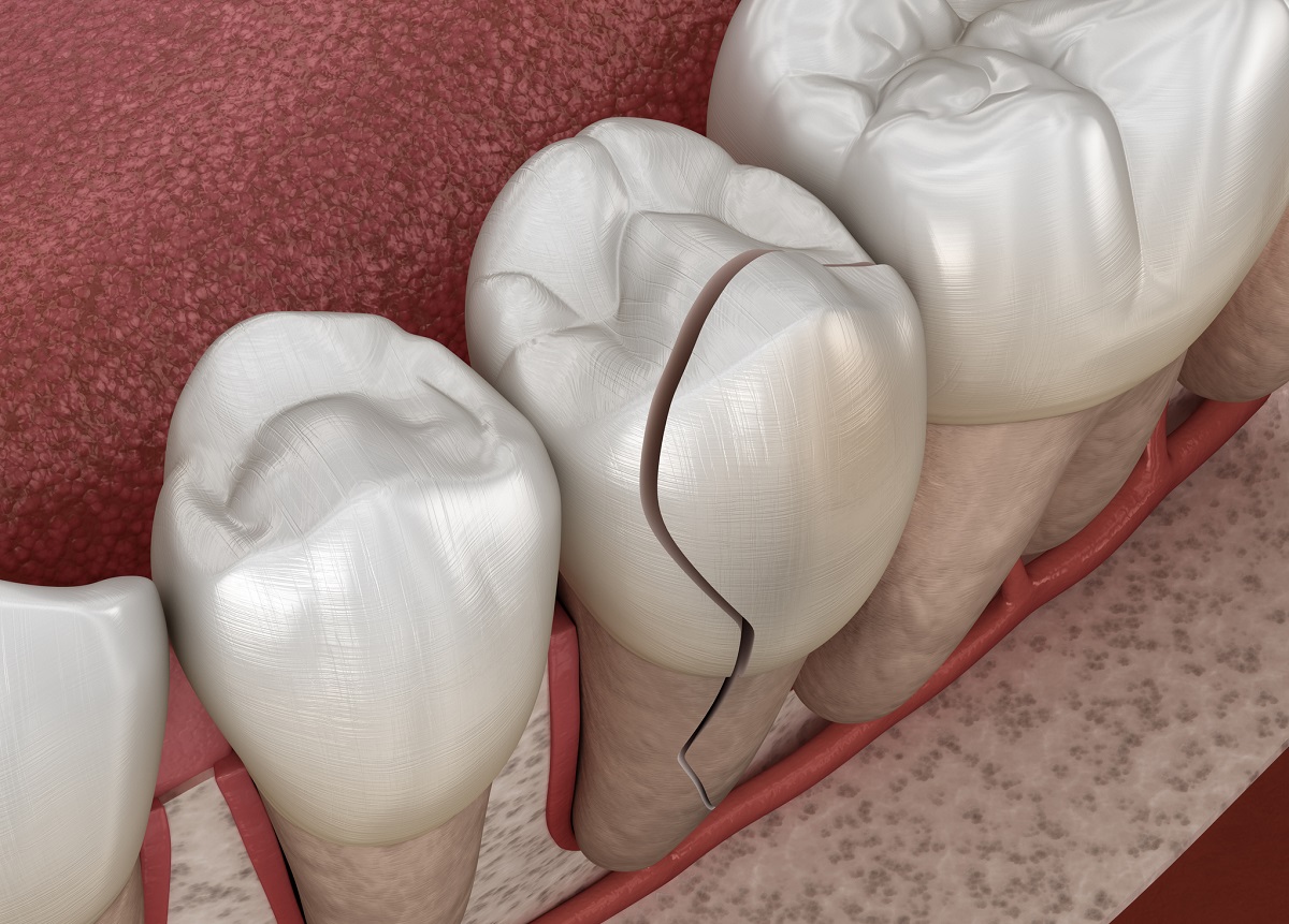 Znázornenie zlomeniny korunky zasahujúcej po koreň zuba